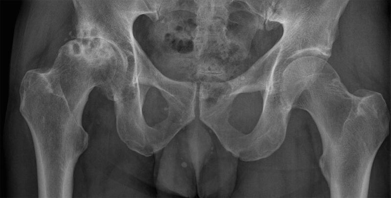 3 ступінь артрозу кульшового суглоба на рентгені