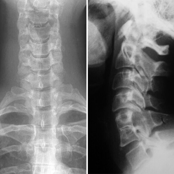 X -ray of шийний хребет