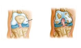патологічні зміни при колінному артрозі