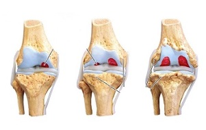 стадії розвитку артрозу колінного суглоба