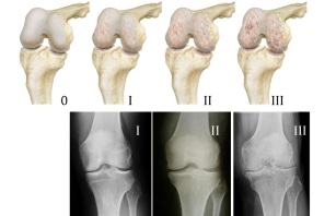 методи діагностика артрозу коліна