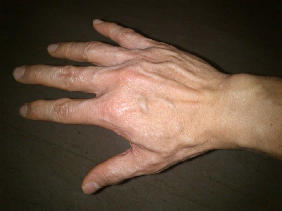 деформація кісток та болі в суглобах пальців рук