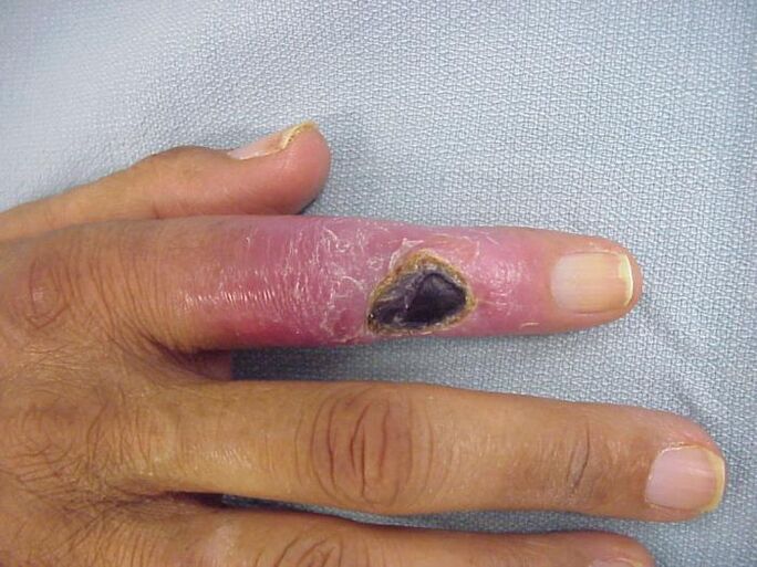 остеомієліт як причина болю в суглобах пальці рук