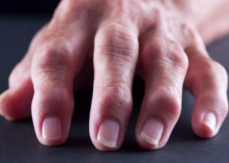 ревматоїдний артрит як причина болю у суглобах пальців рук
