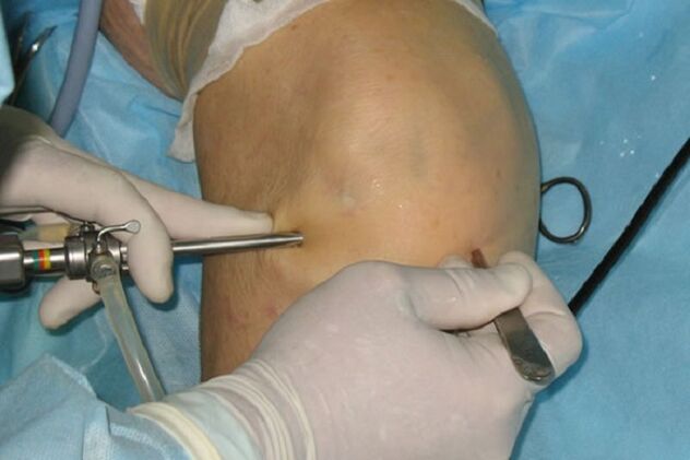 артроскопія при болі в коліні